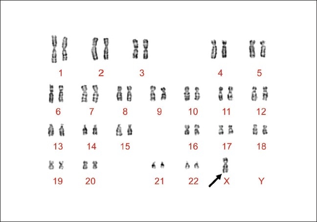 Karyotype_of_proband_with_Neurofibromatosis_type_1,_Tuberous_Sclerosis_complex_and_Turner_Syndrome._The_arrow_indicates_the_presence_of_only_one_X_chromosome_in_Karyotype