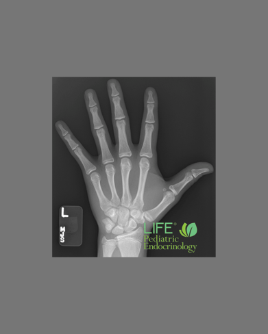 bone age hand X-ray showing skeletal maturity in pediatric patient